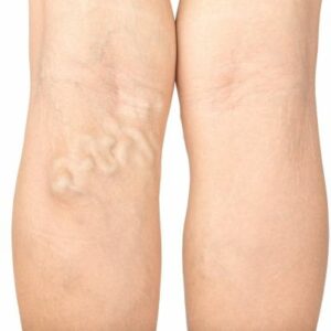 varicose veins on the back of a person’s upper leg