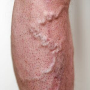 varicose veins on a man’s upper leg
