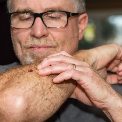 Middle-aged man examines a mark on his arm.